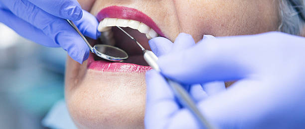 Best Emergency Dentist for Lost Fillings or Crowns in East Lake, FL